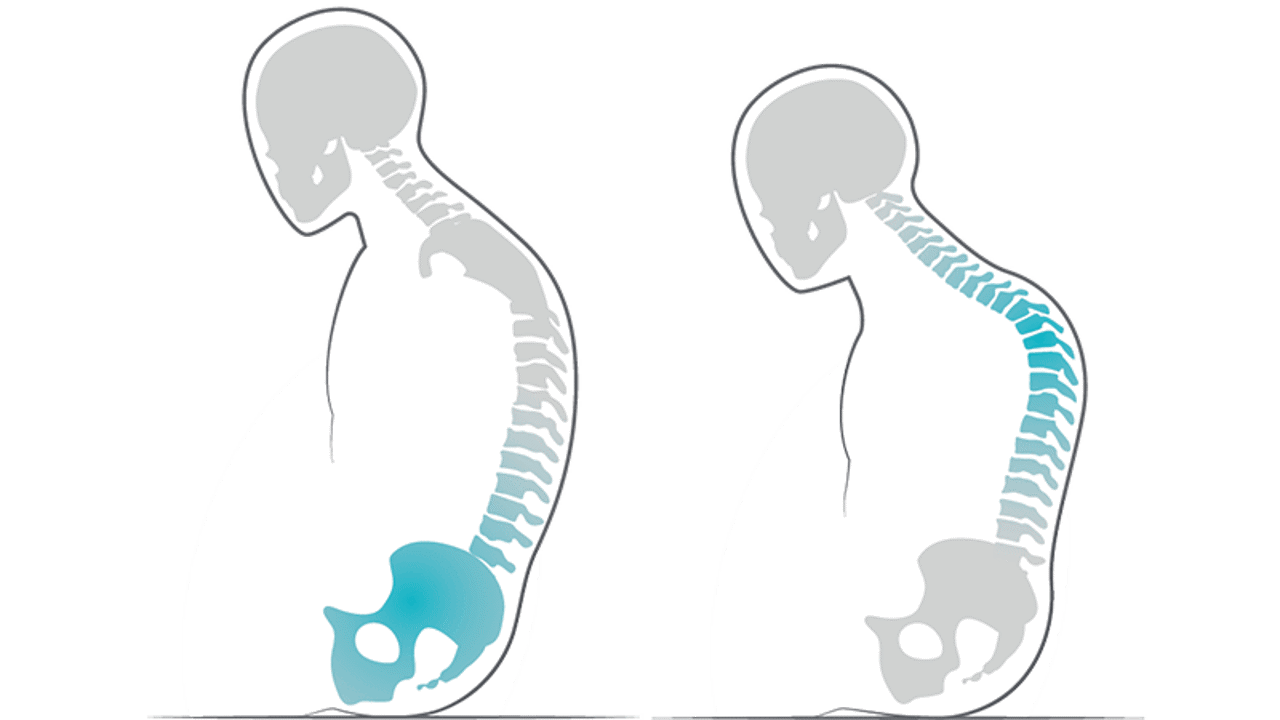 /globalassets/0-sweden/utbildning/kroppsformer--swift-mobil-2/4-pelvistilt-kyphosis-800x450.png?width=1280&Quality=90&rmode=max&scale=down