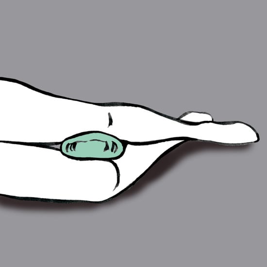 Rhombo-Fill® stödring